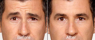 Botox & Dermal Fillers Before & After Photos in Syracuse, New York at CNY Cosmetic & Reconstructive Surgery