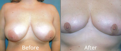 Breast Reduction Before & After Photos in Syracuse, New York at CNY Cosmetic & Reconstructive Surgery