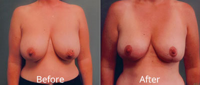 Breast Reduction Before & After Photos in Syracuse, New York at CNY Cosmetic & Reconstructive Surgery