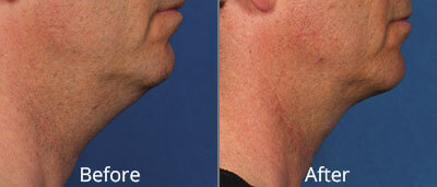 Kybella Before & After Photos in Syracuse, New York at CNY Cosmetic & Reconstructive Surgery