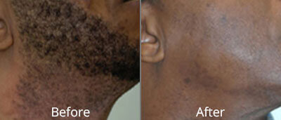 Laser Hair Removal & Waxing Before & After Photos in Syracuse, New York at CNY Cosmetic & Reconstructive Surgery