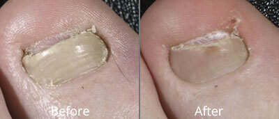 Laser Nail Fungus Treatment Before & After Photos in Syracuse, New York at CNY Cosmetic & Reconstructive Surgery