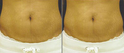 Laser Skin Tightening Before & After Photos in Syracuse, New York at CNY Cosmetic & Reconstructive Surgery