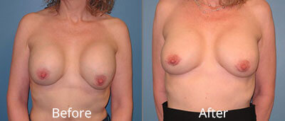 Other Breast Procedures Before & After Photos in Syracuse, New York at CNY Cosmetic & Reconstructive Surgery