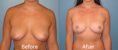 Breast Lift Before & After Photos in Syracuse, New York at CNY Cosmetic & Reconstructive Surgery