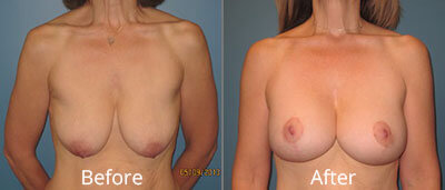 Breast Lift Before & After Photos in Syracuse, New York at CNY Cosmetic & Reconstructive Surgery