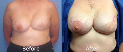 Breast Reconstruction Before & After Photos in Syracuse, New York at CNY Cosmetic & Reconstructive Surgery