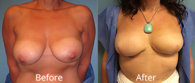 Breast Reconstruction Before & After Photos in Syracuse, New York at CNY Cosmetic & Reconstructive Surgery