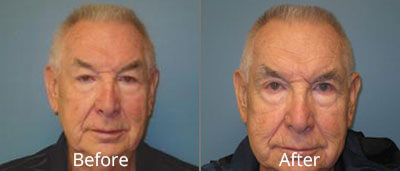 Brow Lift Before & After Photos in Syracuse, New York at CNY Cosmetic & Reconstructive Surgery