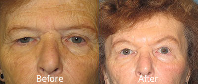 Brow Lift Before & After Photos in Syracuse, New York at CNY Cosmetic & Reconstructive Surgery