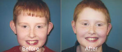 Ear Surgery Before & After Photos in Syracuse, New York at CNY Cosmetic & Reconstructive Surgery