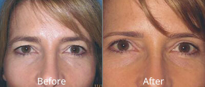 Eyelid Surgery Before & After Photos in Syracuse, New York at CNY Cosmetic & Reconstructive Surgery
