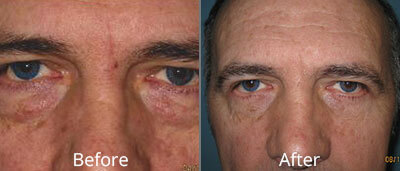 Eyelid Surgery Before & After Photos in Syracuse, New York at CNY Cosmetic & Reconstructive Surgery