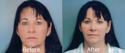 Facelift & Neck Lift Before & After Photos in Syracuse, New York at CNY Cosmetic & Reconstructive Surgery