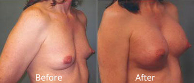 Gender Reassignment Before & After Photos in Syracuse, New York at CNY Cosmetic & Reconstructive Surgery
