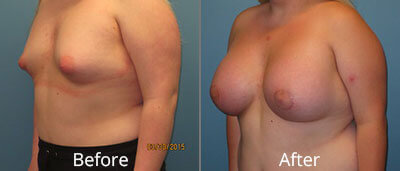 Gender Reassignment Before & After Photos in Syracuse, New York at CNY Cosmetic & Reconstructive Surgery