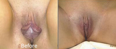 Labiaplasty Before & After Photos in Syracuse, New York at CNY Cosmetic & Reconstructive Surgery