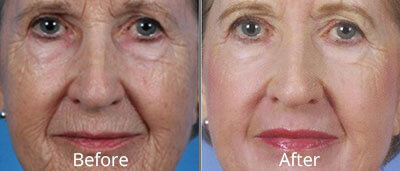 Laser Skin Resurfacing Before & After Photos in Syracuse, New York at CNY Cosmetic & Reconstructive Surgery