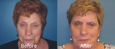 Laser Skin Resurfacing Before & After Photos in Syracuse, New York at CNY Cosmetic & Reconstructive Surgery