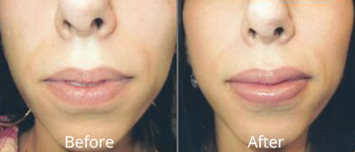 Lip Implants Before & After Photos in Syracuse, New York at CNY Cosmetic & Reconstructive Surgery