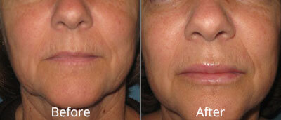 Lip Implants Before & After Photos in Syracuse, New York at CNY Cosmetic & Reconstructive Surgery