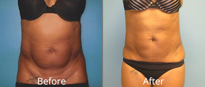 Liposuction Before & After Photos in Syracuse, New York at CNY Cosmetic & Reconstructive Surgery