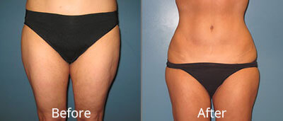 Lyposuction Before & After Photos in Syracuse, New York at CNY Cosmetic & Reconstructive Surgery
