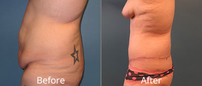 Lower Body Lift Before & After Photos in Syracuse, New York at CNY Cosmetic & Reconstructive Surgery