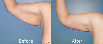Lower Body Lift Before & After Photos in Syracuse, New York at CNY Cosmetic & Reconstructive Surgery