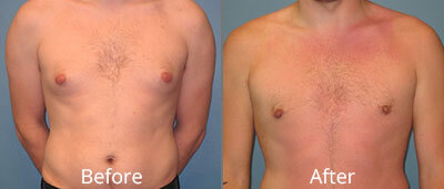 Male Breast Reduction Before & After Photos in Syracuse, New York at CNY Cosmetic & Reconstructive Surgery