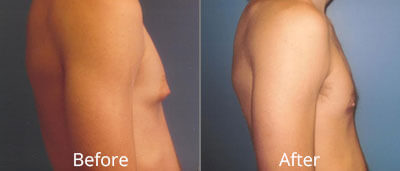 Male Breast Reduction Before & After Photos in Syracuse, New York at CNY Cosmetic & Reconstructive Surgery