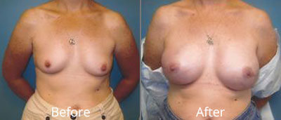 Mastectomy Procedures Before & After Photos in Syracuse, New York at CNY Cosmetic & Reconstructive Surgery