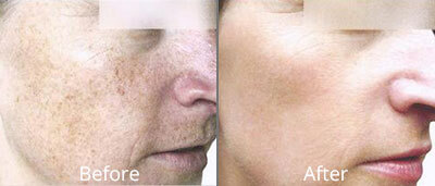 Photofacials Before & After Photos in Syracuse, New York at CNY Cosmetic & Reconstructive Surgery