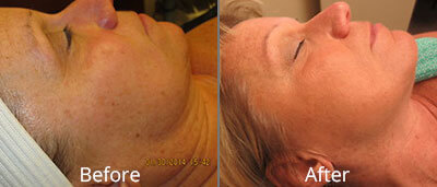 Photofacials Before & After Photos in Syracuse, New York at CNY Cosmetic & Reconstructive Surgery