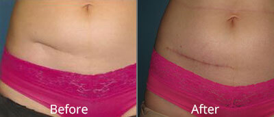 Scar Revisions Before & After Photos in Syracuse, New York at CNY Cosmetic & Reconstructive Surgery