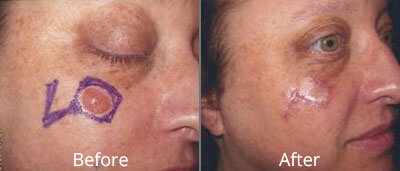 Skin Cancer Diagnosis & Treatment Before & After Photos in Syracuse, New York at CNY Cosmetic & Reconstructive Surgery