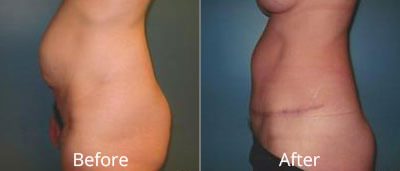 Tummy Tuck Before & After Photos in Syracuse, New York at CNY Cosmetic & Reconstructive Surgery
