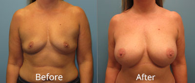 Breast Augmentation Before & After Photos in Syracuse, New York at CNY Cosmetic & Reconstructive Surgery