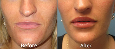 Facelift & Neck Lift Before & After Photos in Syracuse, New York at CNY Cosmetic & Reconstructive Surgery