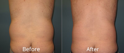 Liposuction Before & After Photos in Syracuse, New York at CNY Cosmetic & Reconstructive Surgery