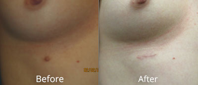 Mastectomy Procedures Before & After Photos in Syracuse, New York at CNY Cosmetic & Reconstructive Surgery