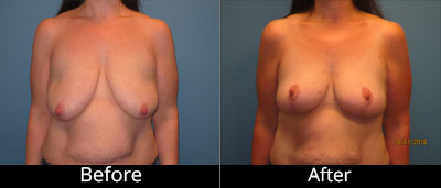 Breast Augmentation Before & After Photos in Syracuse, New York at CNY Cosmetic & Reconstructive Surgery