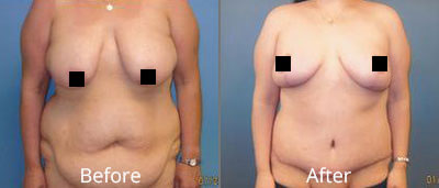 Tummy Tuck Before & After Photos in Syracuse, New York at CNY Cosmetic & Reconstructive Surgery