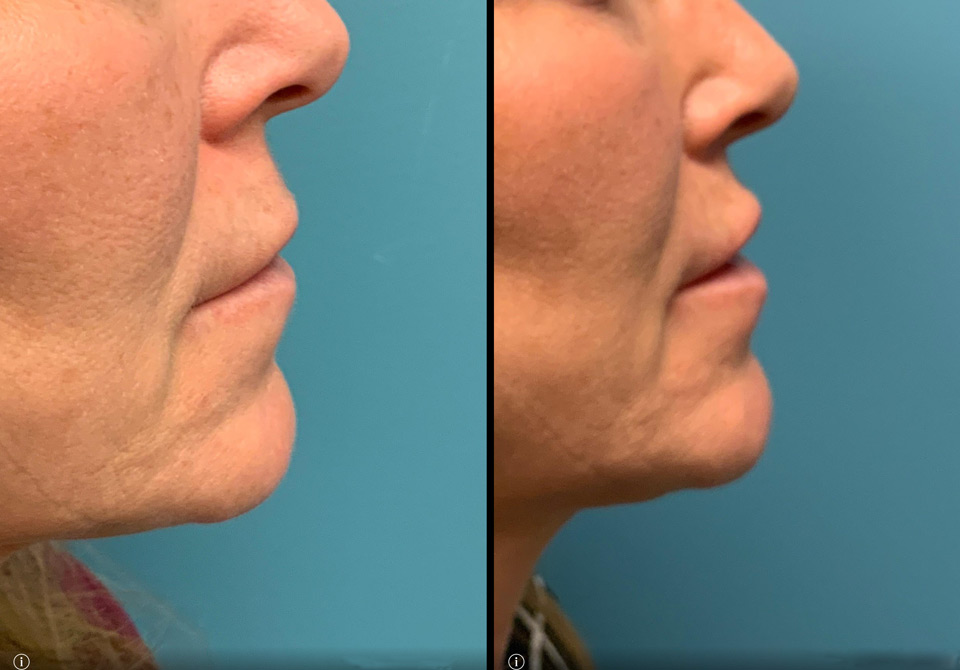Lip Lift Before & After Photos in Syracuse, New York at CNY Cosmetic & Reconstructive Surgery