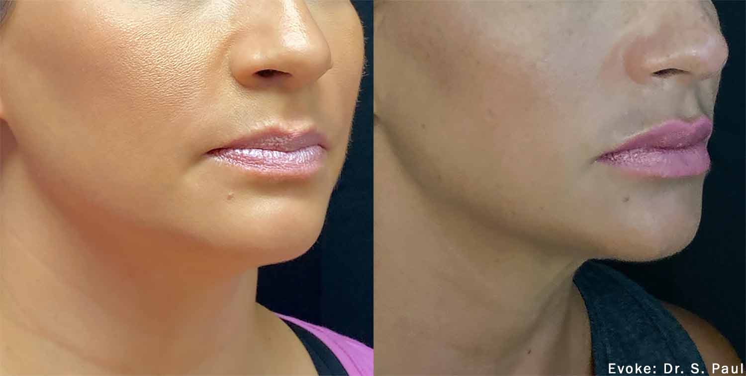 Botox & Dermal Fillers Before & After Photos in Syracuse, New York at CNY Cosmetic & Reconstructive Surgery